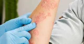 এলার্জির কারণ, ঘরোয়া প্রতিকার ও চিকিৎসা