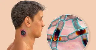 অ্যানথ্রাক্স: লক্ষণ, কীভাবে ছড়ায় ও চিকিৎসা