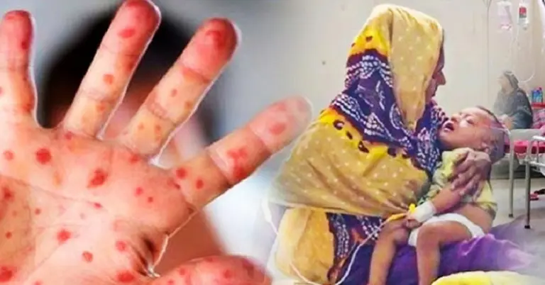 ২৪ ঘণ্টায় হাম ও উপসর্গে আরও ১০ শিশুর মৃত্যু