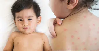দেশজুড়ে হামের প্রকোপ: শিশু সুরক্ষায় যা জানা জরুরি, চিনে নিন লক্ষণ ও প্রতিকার