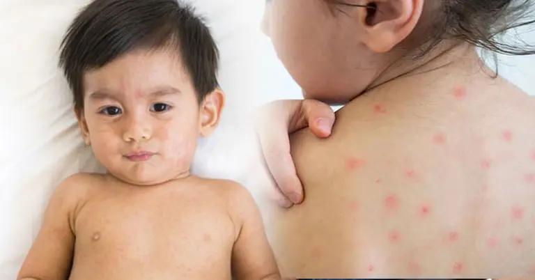শিশুদের হাম হলে করনীয়