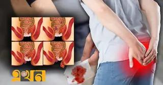 পাইলসের লক্ষণ, প্রতিকার ও চিকিৎসা