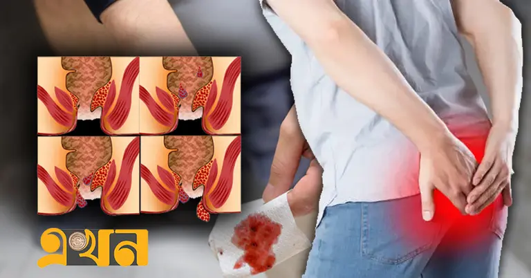 পাইলস বা অর্শরোগ