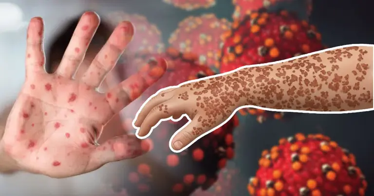 বড়দের হাম হওয়ার লক্ষণ