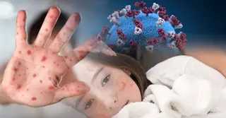 হামের সংস্পর্শে এলে কী করবেন? সংক্রমণ ঠেকাতে যা করবেন