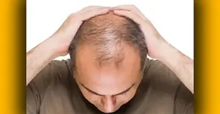 পুরুষদের মাথায় টাক পড়ার প্রবণতা বেশি কেন?