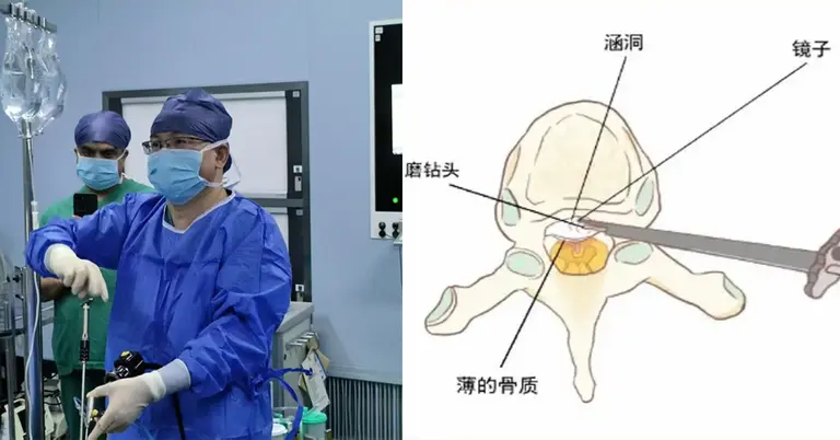 অস্ত্রোপচারে চীনের নতুন প্রযুক্তি ইউবিডি